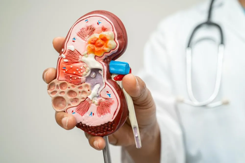 CÂNCER DE RIM PODE TER AUMENTO DE QUASE 80% NO BRASIL E ACENDE ALERTA PARA PREVENÇÃO